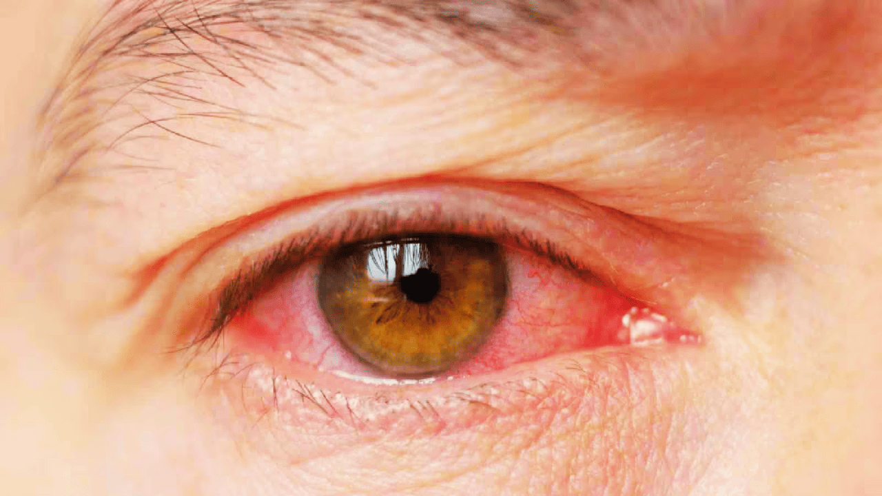 Conjunctivitis in Winter