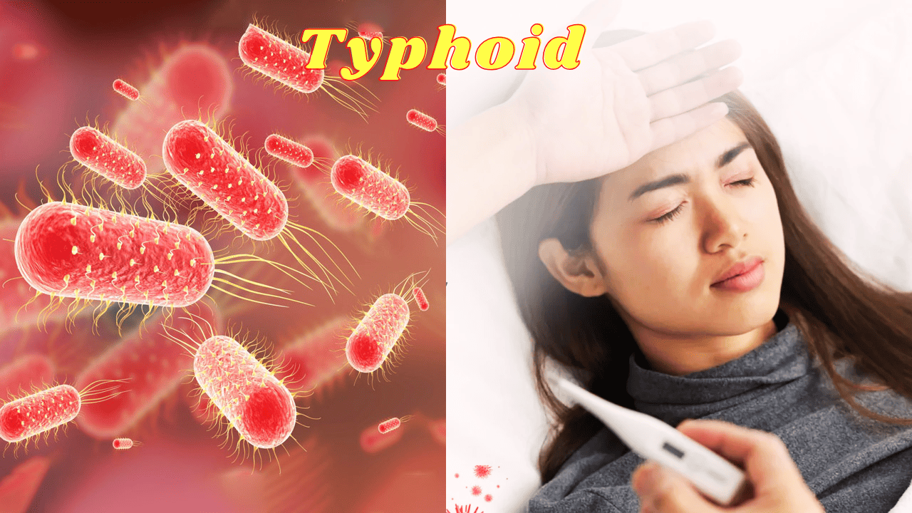 Typhoid